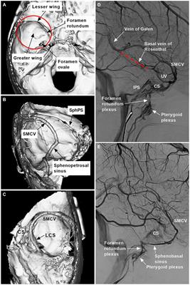 Endovascular treatment for sphenoidal region dural arteriovenous fistula